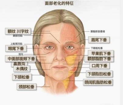 50岁适合哪种面部提拉手术？