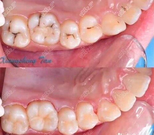 重慶市開州區(qū)皓貝口腔牙齒診療真人實例