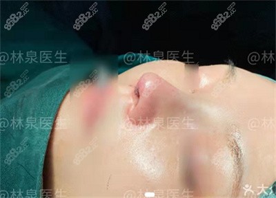 隆鼻术后