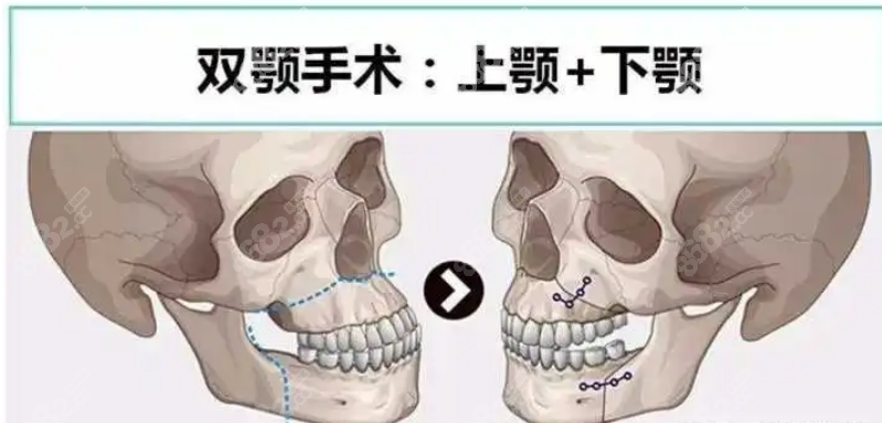 金勇圭医生做得正颌手术的亮点