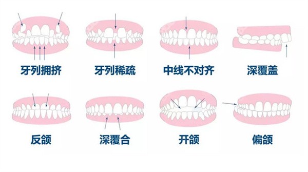 18岁矫正牙齿晚不晚