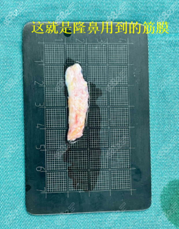 花费2万元找王洛生医生做的假体隆鼻手术