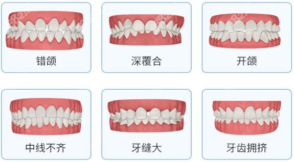邵阳雅贝康口腔可以改善牙缝大的牙齿不齐问题