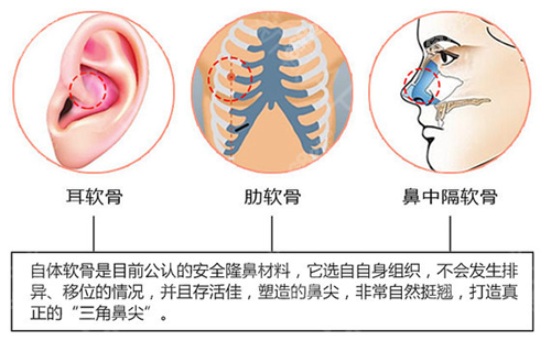 隆鼻几种方式