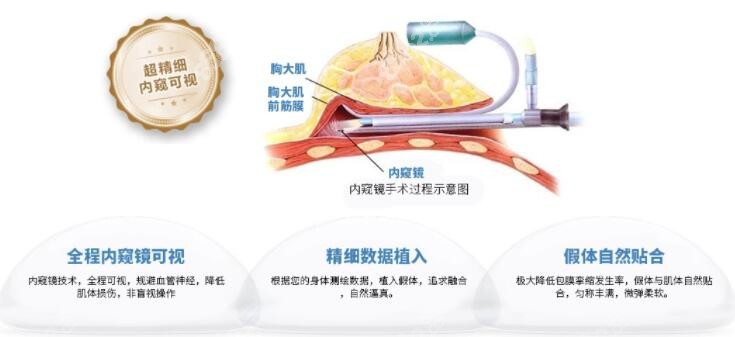 谭式内窥镜隆胸技术