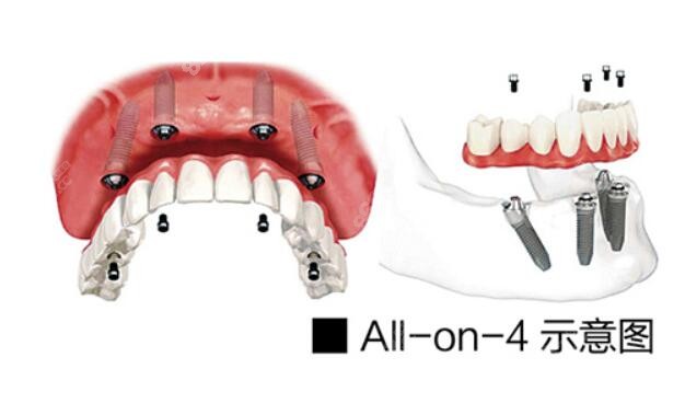 ALL-ON-4全口种植牙