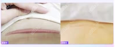 疤痕增生修复