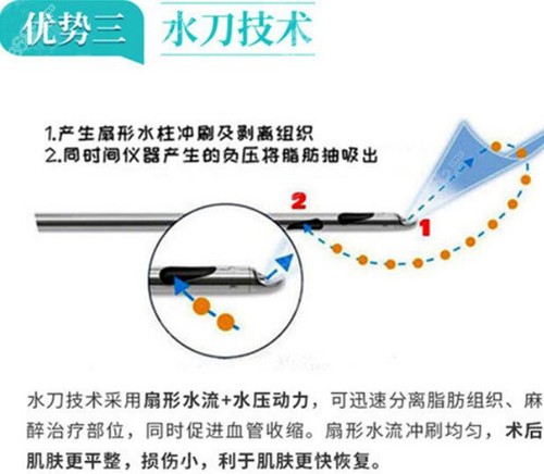 东莞华美整形吸脂优势介绍