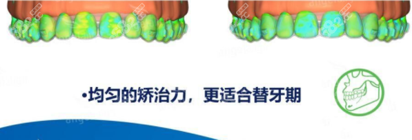 时代天使儿童版A6型号牙套
