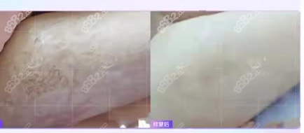 烧伤疤痕20年后修复实例