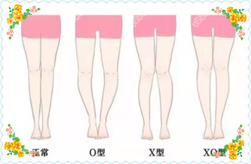 国内腿型矫正哪家医院好？