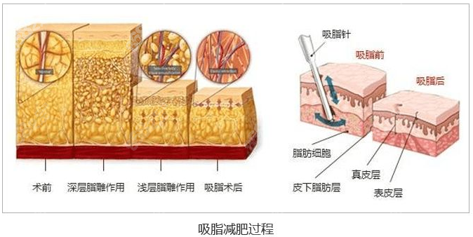 长春吸脂手术出名的医院——吸脂过程