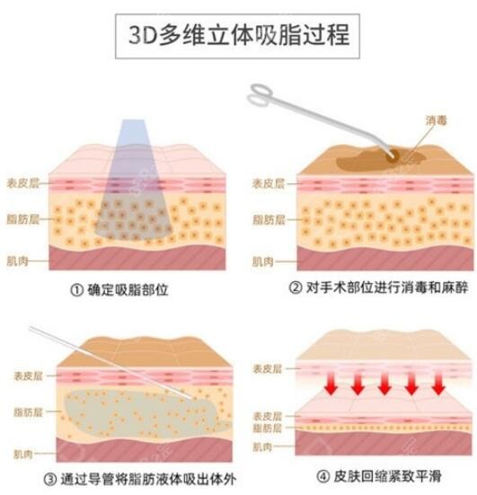 3D多维立体吸脂术过程示意图