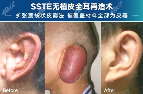 武汉五洲整形耳畸形矫正前后对比照