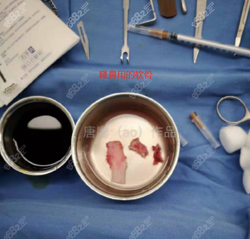 唐鏖医生隆鼻用的软骨