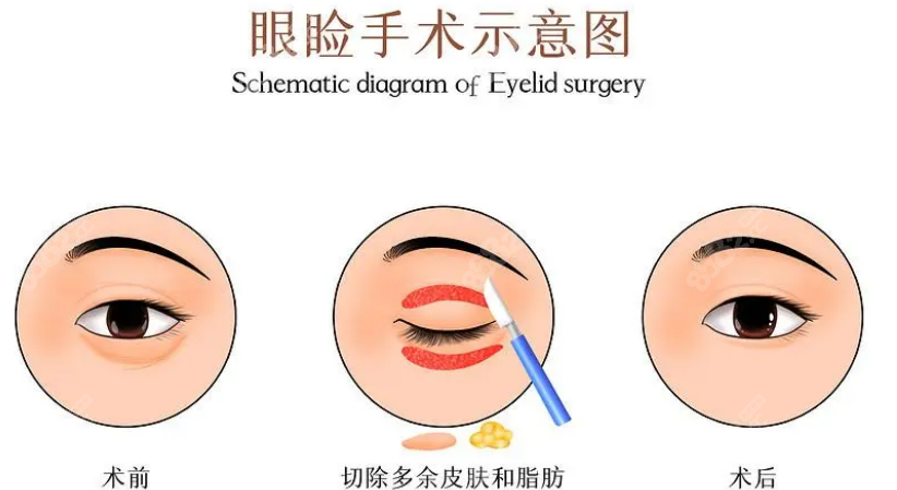 双眼皮手术示意图