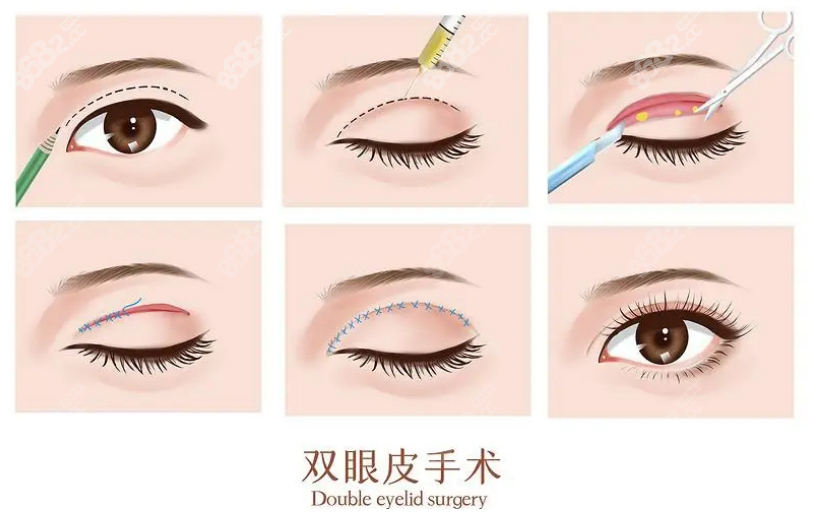 张晶医生做的双眼皮手术
