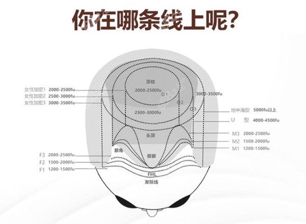 不同程度脱发建议植的毛囊数量参考图