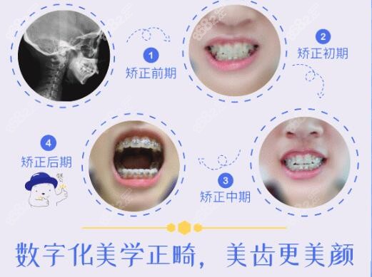 数字化正畸的牙齿变化过程