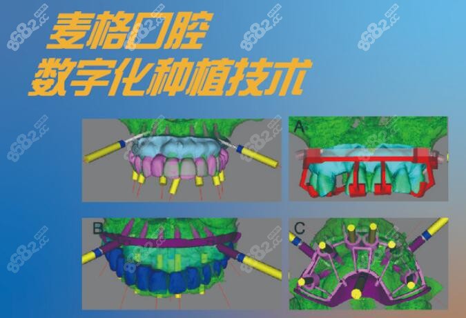 麦格口腔数字化种植技术