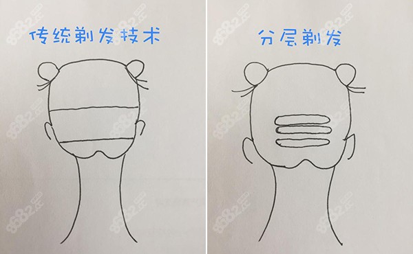 池州灵创分层不剃发植发技术更美观