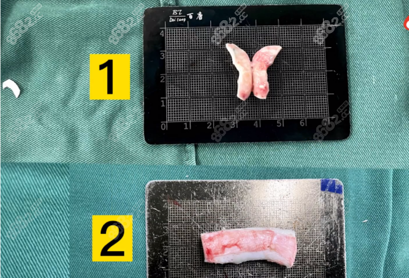 胡志成医生做鼻子用到的耳软骨