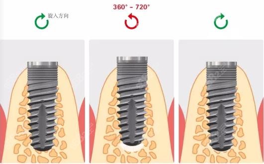 德国sky种植牙的优点——自攻螺旋