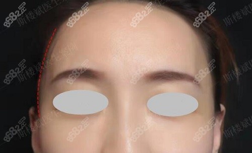 <!--<i data=20240705-sp></i>-->脂肪填充术后