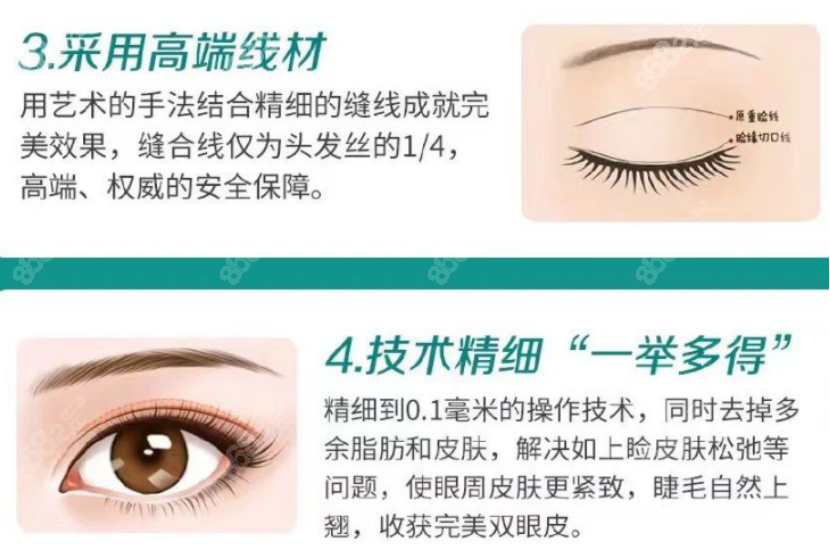 刘庆丰医生做的双眼皮亮点