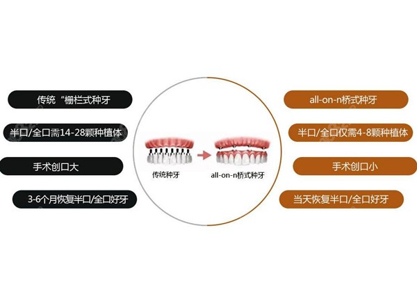 传统与allon4种牙的区别