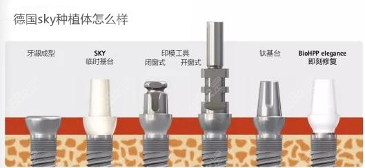 德国sky进口种植牙到底怎么样