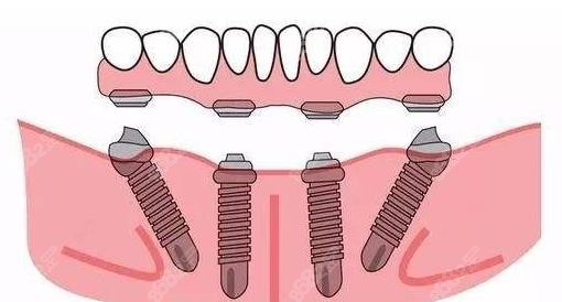 all-on-4种植牙示意图