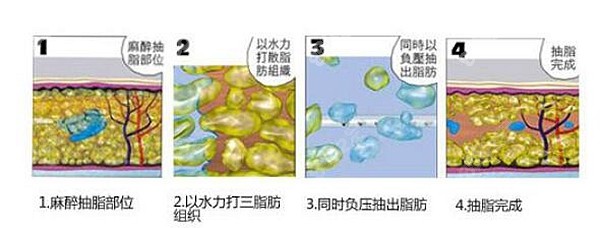 陈孝闯吸脂口碑