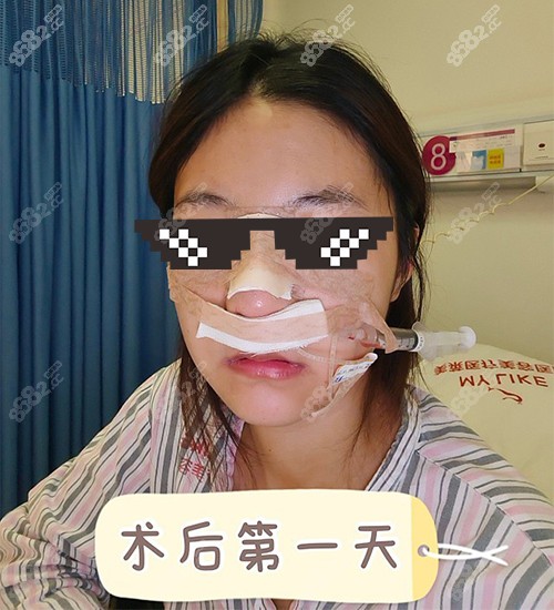 潘卫峰院长做完鼻子后