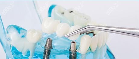 沈阳纽大口腔做奥齿泰种植牙技术怎么样