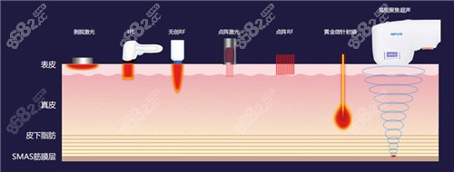 半岛超声炮作用深度达到SMAS筋膜层