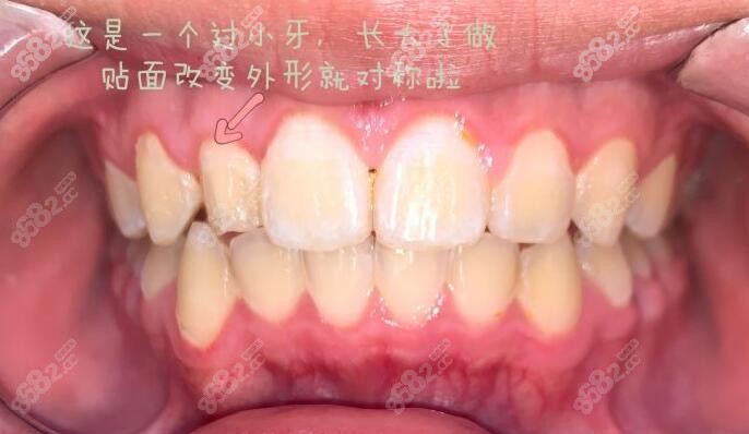 牙齿贴面的术后
