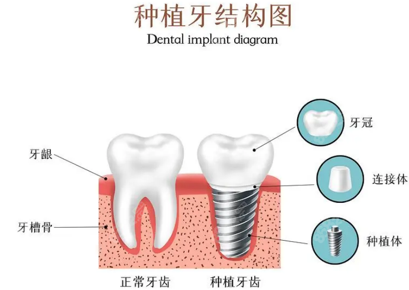 种植牙结构