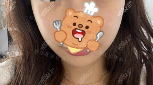 彭喆颧骨+下颌角术后
