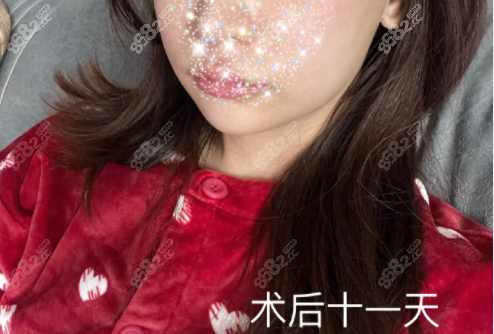 彭喆医生下颌角术后
