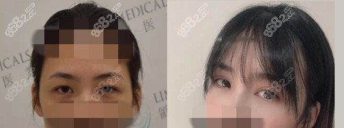北京领医医疗美容做双眼皮前后对比照