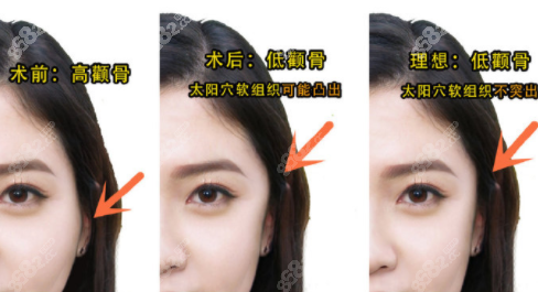 彭喆磨骨术后图