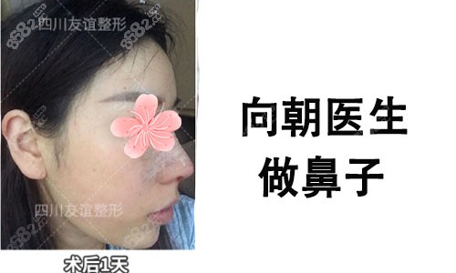 成都向朝医生做鼻子怎么样