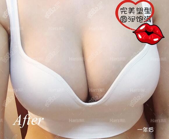 济南韩氏整形医院棉花糖隆胸