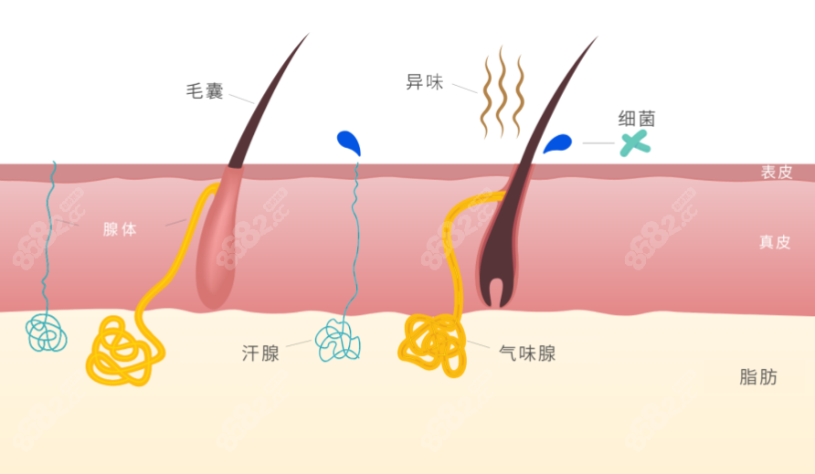 清新微波治腋臭一般多少钱