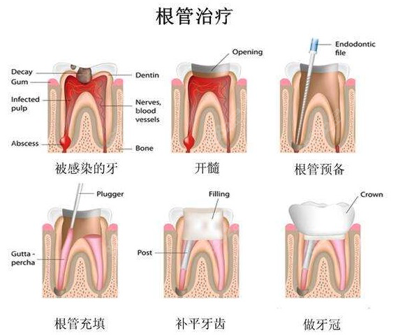 上海根管治疗多少钱