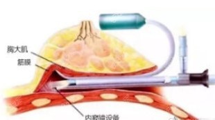 沈阳杏林整形医院内窥镜隆胸