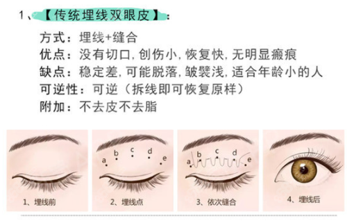 銀川做雙眼皮好看的醫院用的方法是切開埋線還是韓式三點