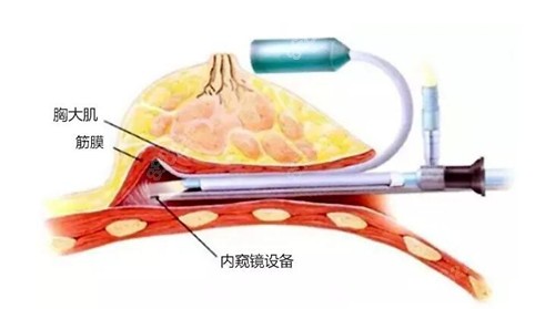 内窥镜隆胸手术优势