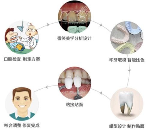 上海华美口腔瓷贴面